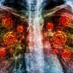 Tanda Utama Pneumonia Akibat Infeksi Bakteri