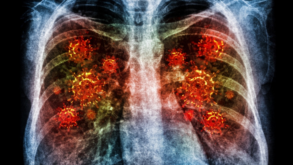 Tanda Utama Pneumonia Akibat Infeksi Bakteri